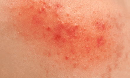 8 Natural Remedies to Treat Diaper Rashes at Home