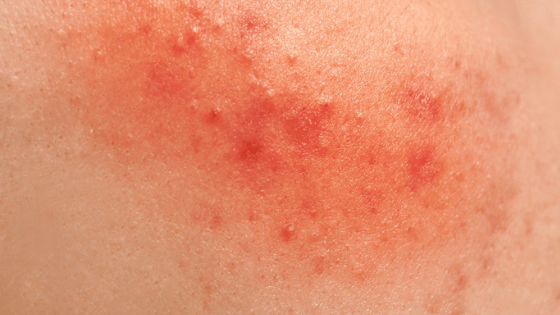 8 Natural Remedies to Treat Diaper Rashes at Home