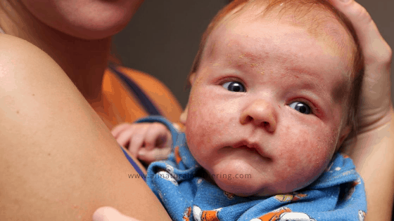 7 Natural Remedies for Baby Eczema